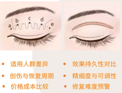 埋线与全切双眼皮