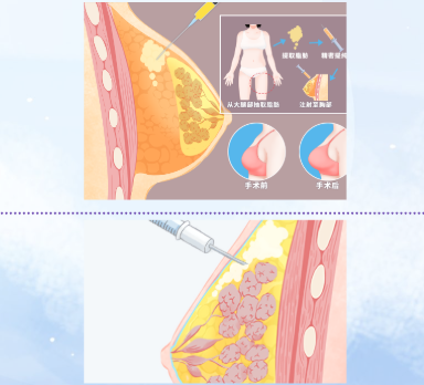 自体脂肪丰胸操作流程