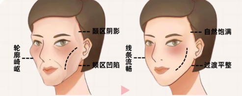 面部凹陷填充解析