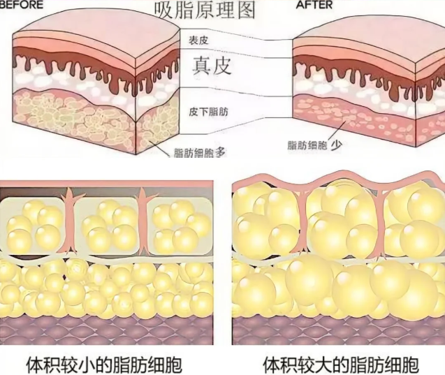 吸脂原理解析