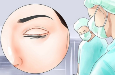 双眼皮整形案例动画