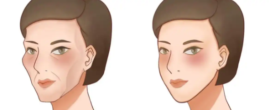 面部凹陷的自体脂肪填充