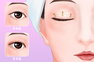 修复双眼皮真实案例图