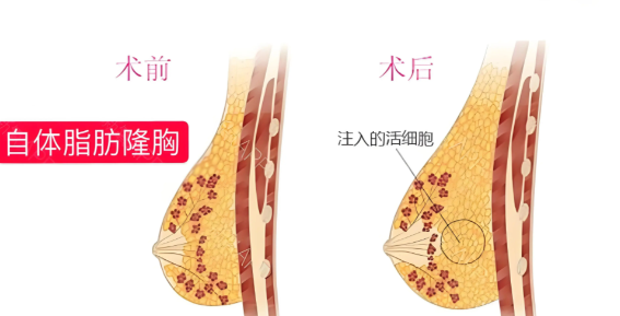自体脂肪丰胸手术的原理