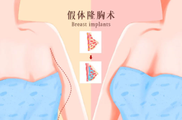 假体隆胸手术案例展示