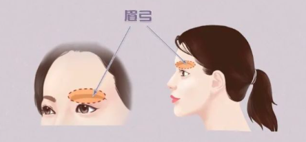 丰眉弓案例展示
